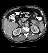 Tumor staging with CT