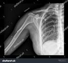 X RAY CLAVICLES SINGLE VIEW