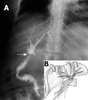 X RAY T-Tube Cholangiography