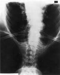 X RAY Thoracic Inlet -Lat