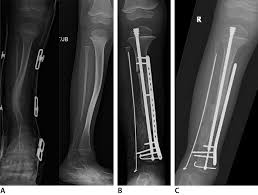 X RAY Tibia & Fibula Oblique view