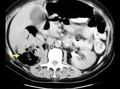 X RAY Urethrogram / RUG / RUCG