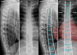 X Ray Thoracic Spine AP/LAT