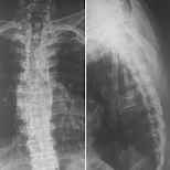 X Ray Thoracolumber AP