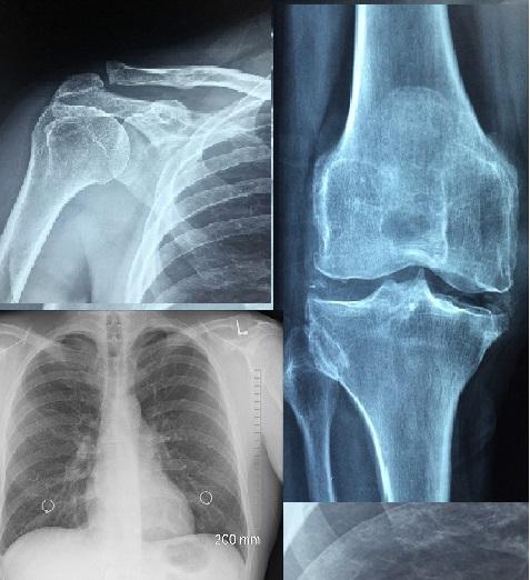 X RAY HUMERUS /FEMUR/HIP AP/LA