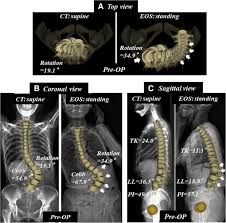 Xray L/S spine Sitting Up and Lying Supine